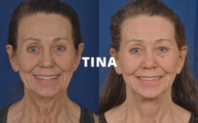 Tina rhinoplasty photos before and after