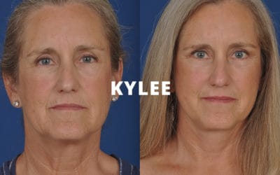 Kylee rhinoplasty before and after photos