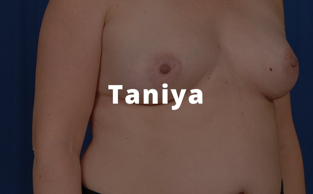 Taniya Breast Breast Augmentation Images