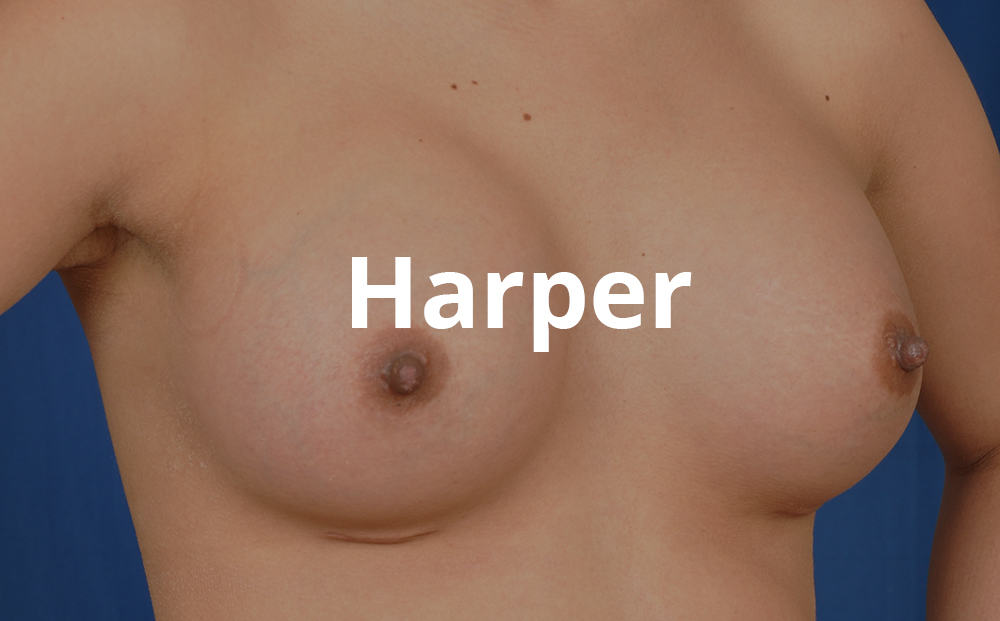 Harper Breast Augmentation Surgery