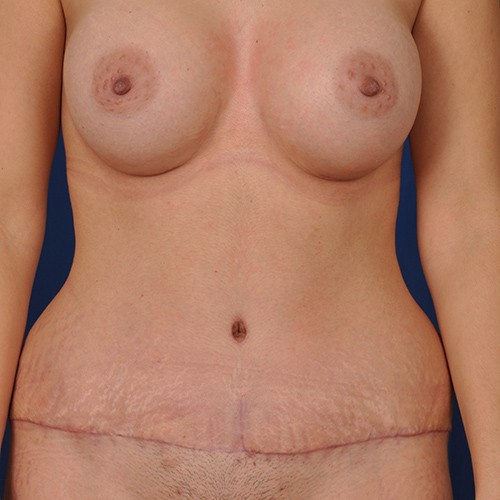 Naomi After Breast Augmentation with Mentor 450cc and Tummy tuck (Abdominoplasty) with low transverse incision