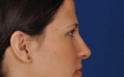 Shea rhinoplasty before and after gallery
