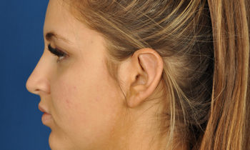 Ear Pinning Before and After Photos Gallery