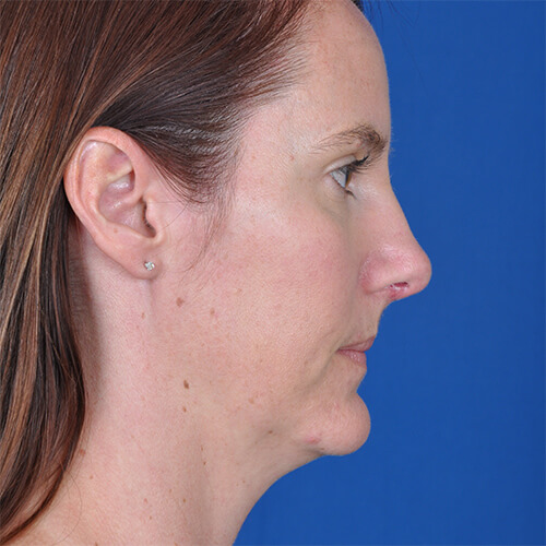 Sage after Open Septo rhinoplasty surgery