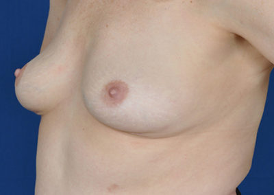sharon breast implant removal